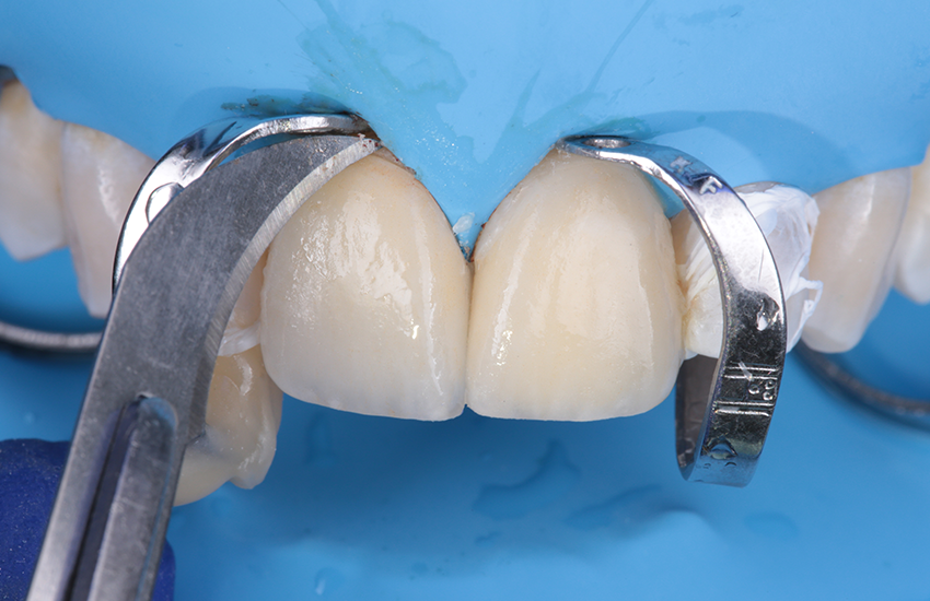 Endgültige Reinigung des überschüssigen Befestigungskomposits mit einer Klinge. Bilder mit freundlicher Genehmigung von Prof. Paulo Monteiro.